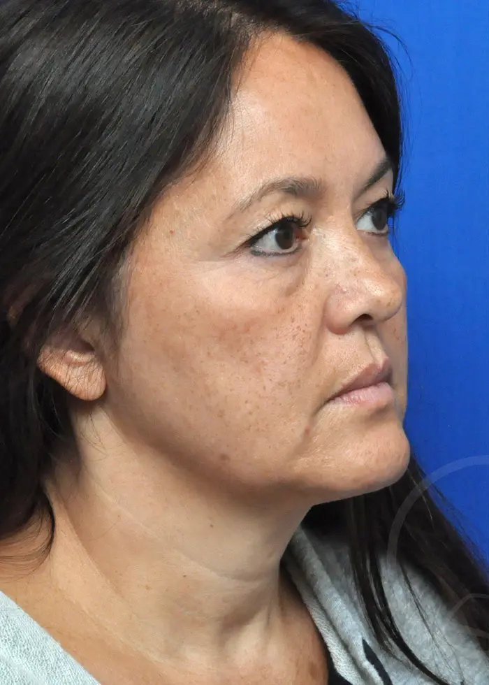 Plastic Surgery Before and After Pictures in Jacksonville, FL - Garcia Facial Plastic Surgery
