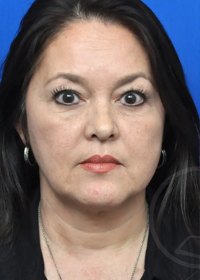 Plastic Surgery Before and After Pictures in Jacksonville, FL - Garcia Facial Plastic Surgery