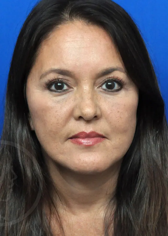 Plastic Surgery Before and After Pictures in Jacksonville, FL - Garcia Facial Plastic Surgery