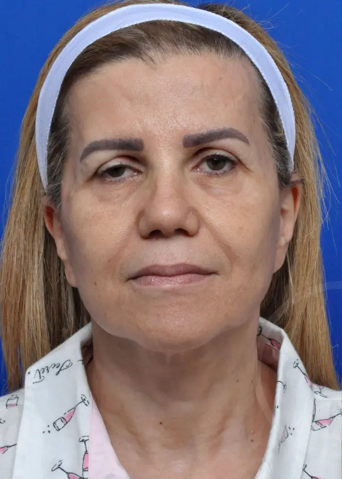 Plastic Surgery Before and After Pictures in Jacksonville, FL - Garcia Facial Plastic Surgery