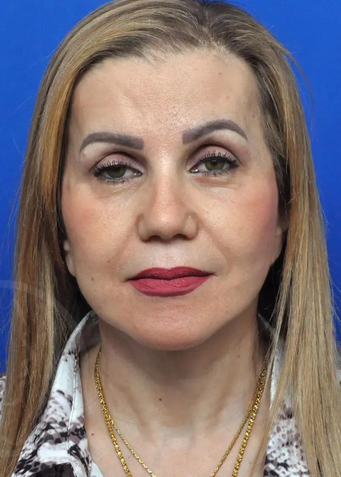 Plastic Surgery Before and After Pictures in Jacksonville, FL - Garcia Facial Plastic Surgery