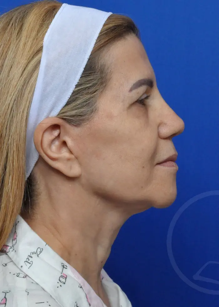 Plastic Surgery Before and After Pictures in Jacksonville, FL - Garcia Facial Plastic Surgery