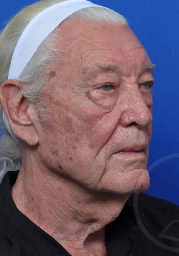 Plastic Surgery Before and After Pictures in Jacksonville, FL - Garcia Facial Plastic Surgery