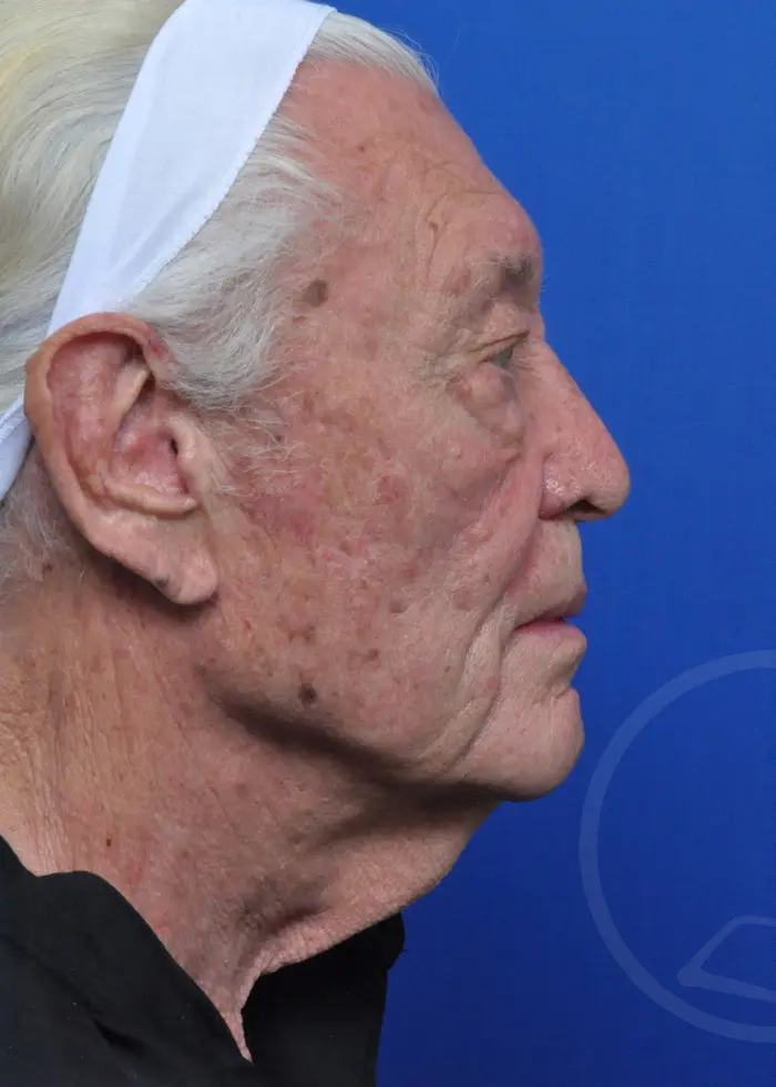 Plastic Surgery Before and After Pictures in Jacksonville, FL - Garcia Facial Plastic Surgery