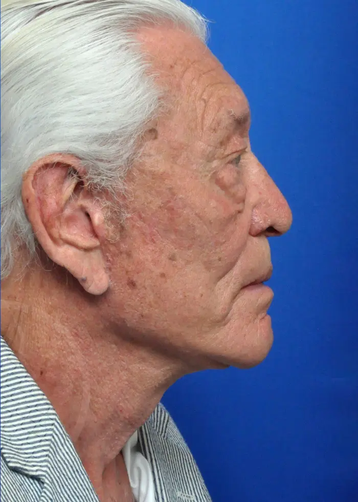 Plastic Surgery Before and After Pictures in Jacksonville, FL - Garcia Facial Plastic Surgery