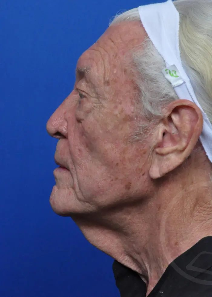 Plastic Surgery Before and After Pictures in Jacksonville, FL - Garcia Facial Plastic Surgery