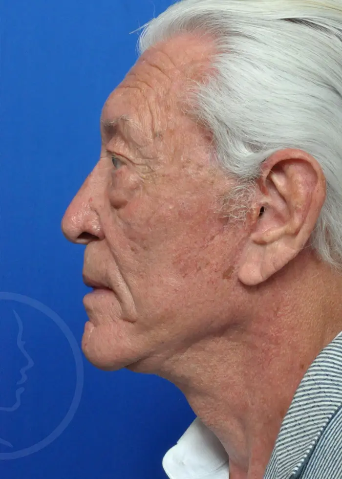 Plastic Surgery Before and After Pictures in Jacksonville, FL - Garcia Facial Plastic Surgery