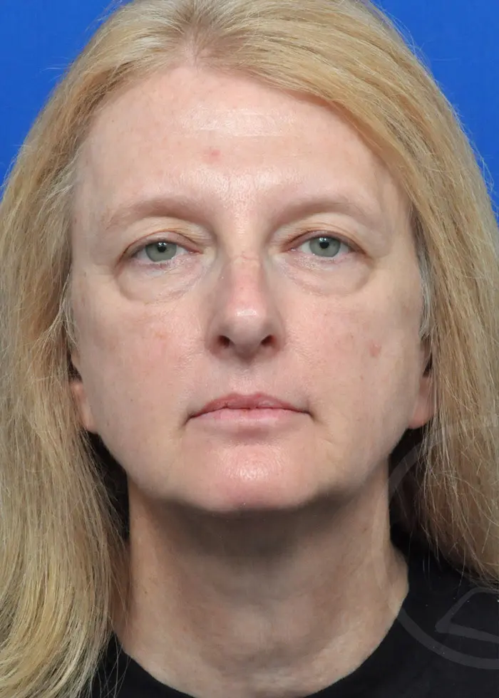 Plastic Surgery Before and After Pictures in Jacksonville, FL - Garcia Facial Plastic Surgery