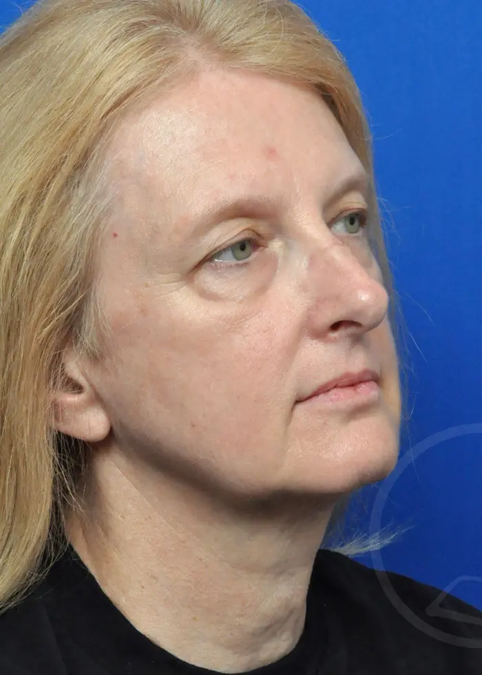 Plastic Surgery Before and After Pictures in Jacksonville, FL - Garcia Facial Plastic Surgery