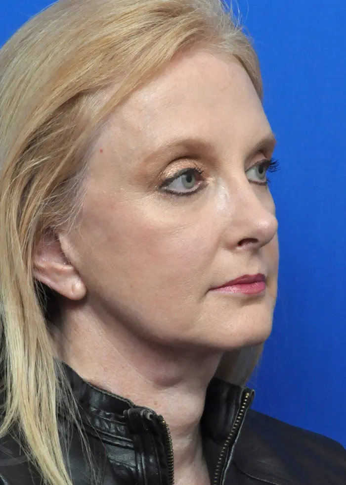 Plastic Surgery Before and After Pictures in Jacksonville, FL - Garcia Facial Plastic Surgery
