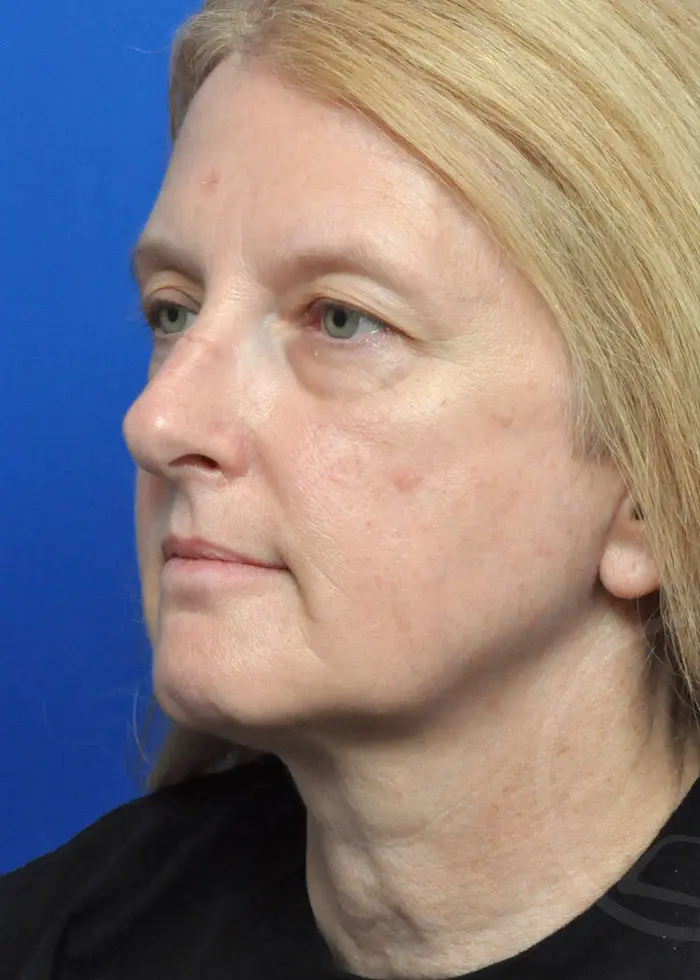 Plastic Surgery Before and After Pictures in Jacksonville, FL - Garcia Facial Plastic Surgery