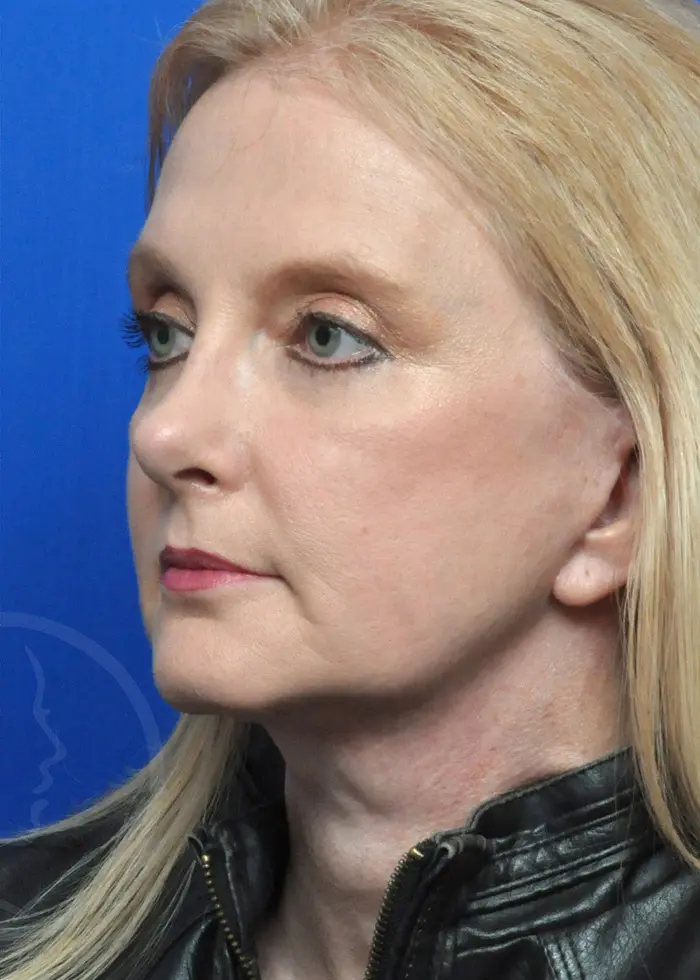 Plastic Surgery Before and After Pictures in Jacksonville, FL - Garcia Facial Plastic Surgery