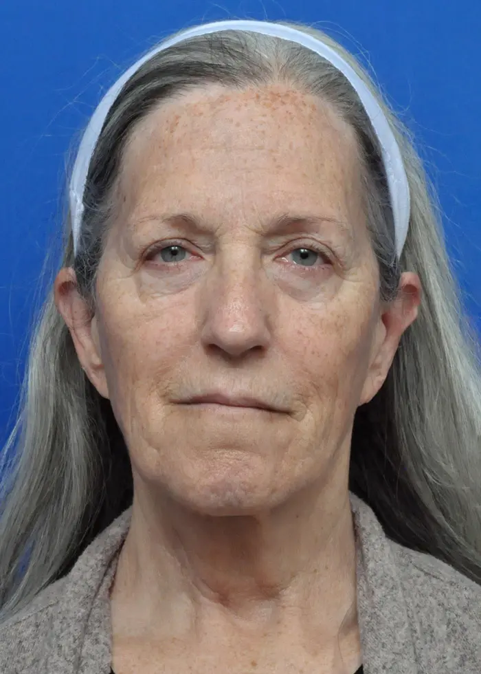 Plastic Surgery Before and After Pictures in Jacksonville, FL - Garcia Facial Plastic Surgery