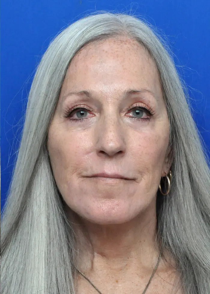 Plastic Surgery Before and After Pictures in Jacksonville, FL - Garcia Facial Plastic Surgery