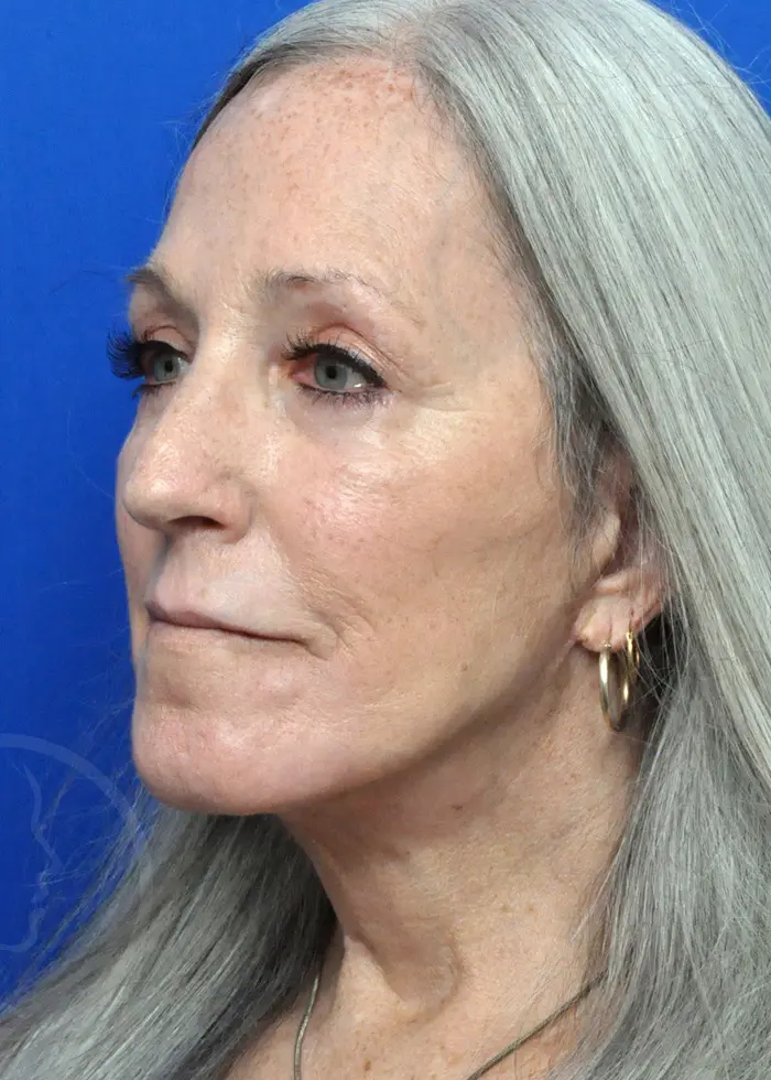 Plastic Surgery Before and After Pictures in Jacksonville, FL - Garcia Facial Plastic Surgery