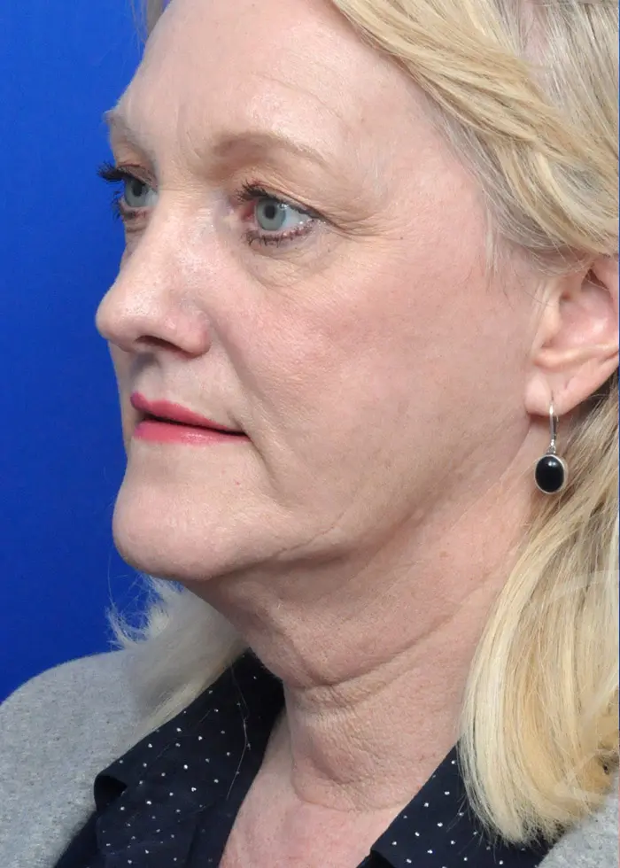 Plastic Surgery Before and After Pictures in Jacksonville, FL - Garcia Facial Plastic Surgery