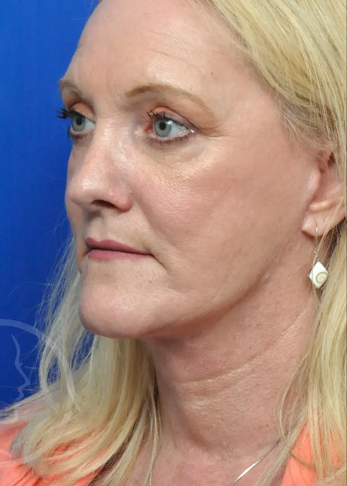 Plastic Surgery Before and After Pictures in Jacksonville, FL - Garcia Facial Plastic Surgery