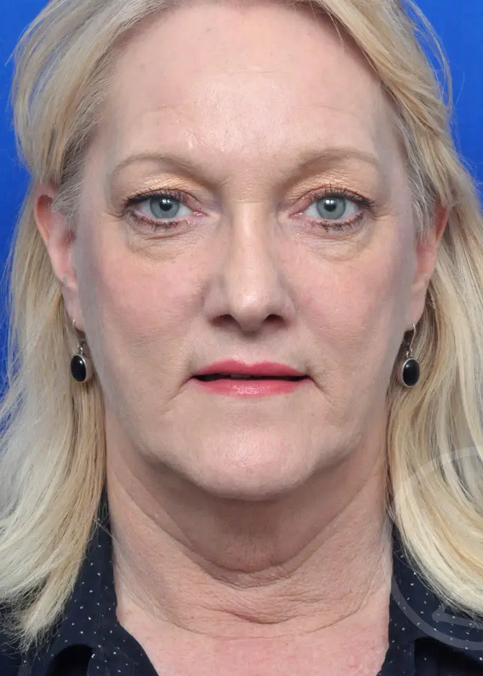 Plastic Surgery Before and After Pictures in Jacksonville, FL - Garcia Facial Plastic Surgery