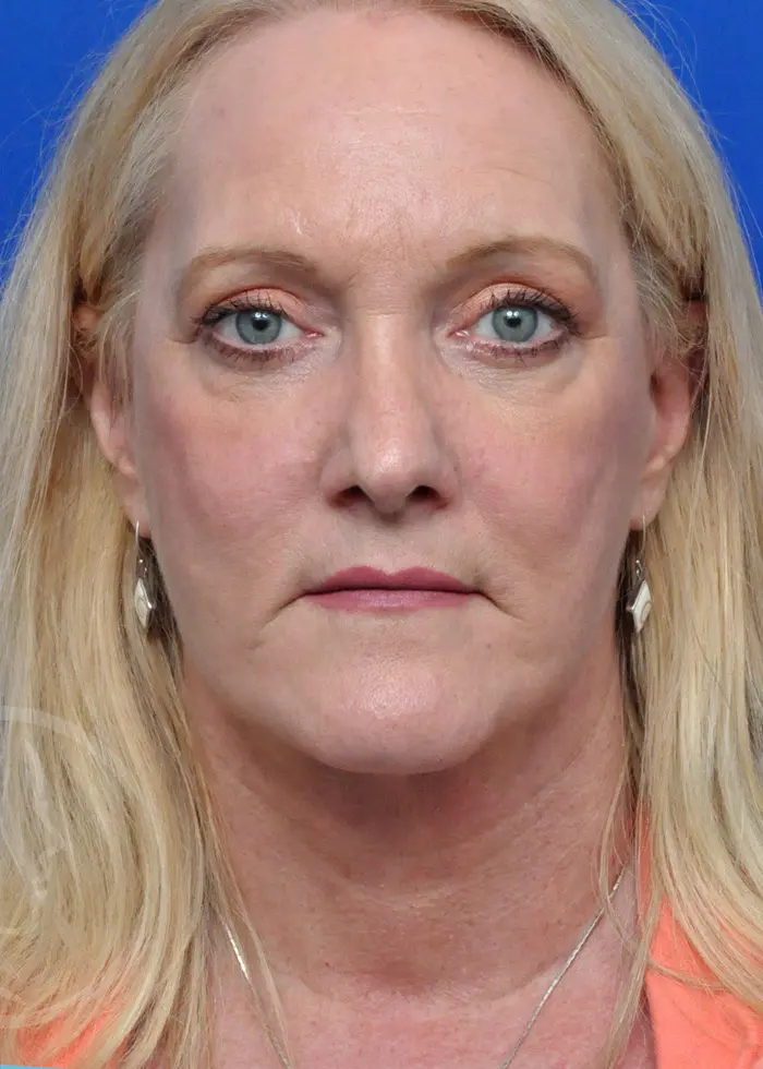 Plastic Surgery Before and After Pictures in Jacksonville, FL - Garcia Facial Plastic Surgery