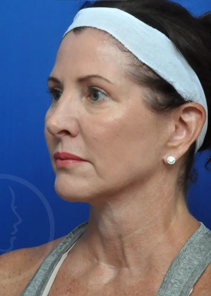Plastic Surgery Before and After Pictures in Jacksonville, FL - Garcia Facial Plastic Surgery