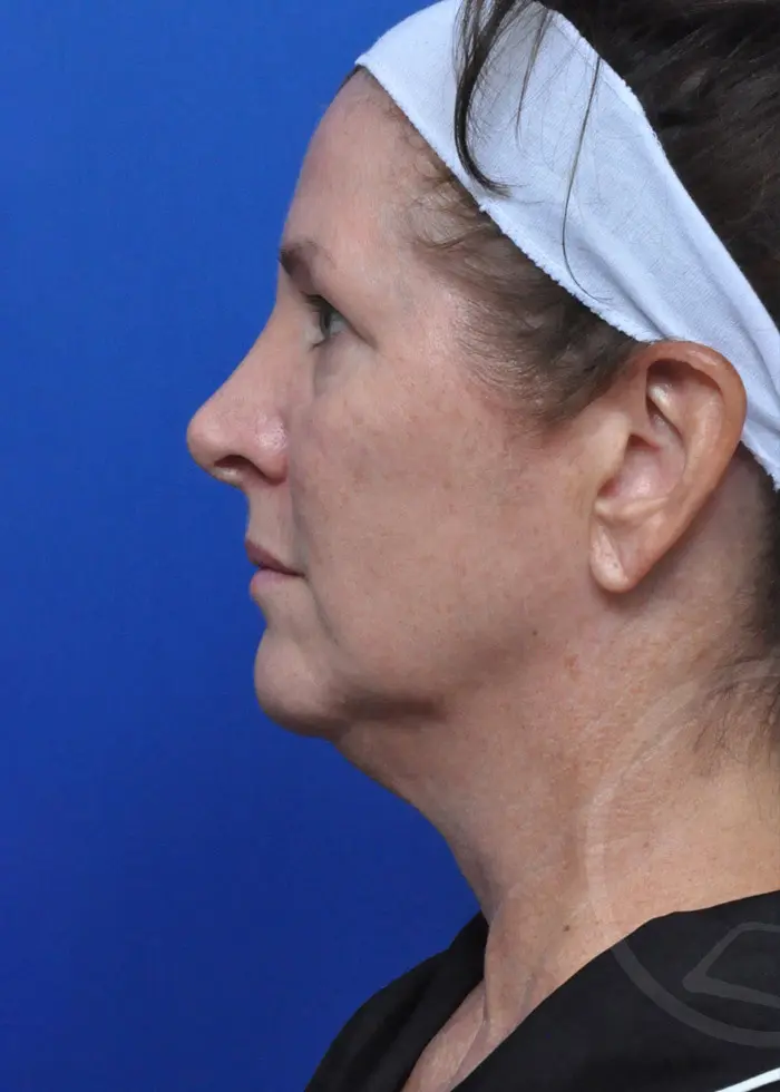 Plastic Surgery Before and After Pictures in Jacksonville, FL - Garcia Facial Plastic Surgery