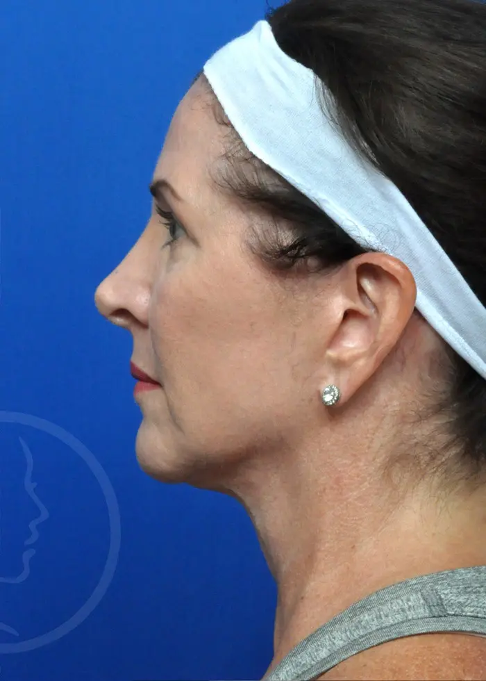 Plastic Surgery Before and After Pictures in Jacksonville, FL - Garcia Facial Plastic Surgery