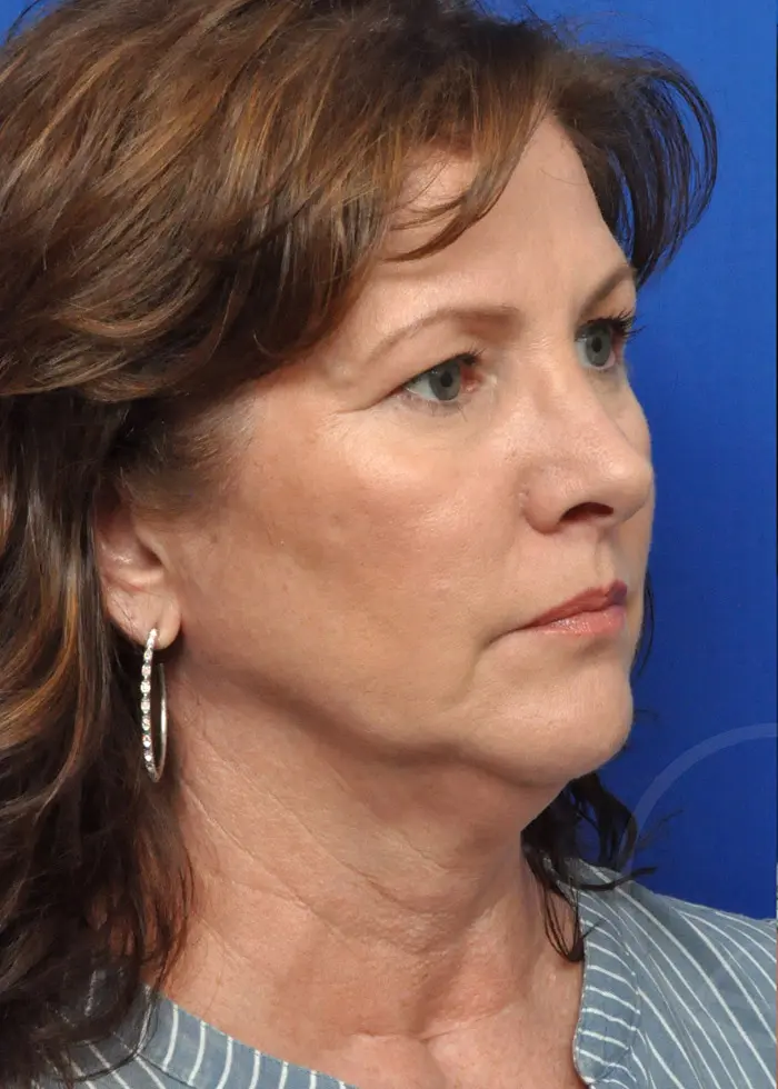 Plastic Surgery Before and After Pictures in Jacksonville, FL - Garcia Facial Plastic Surgery