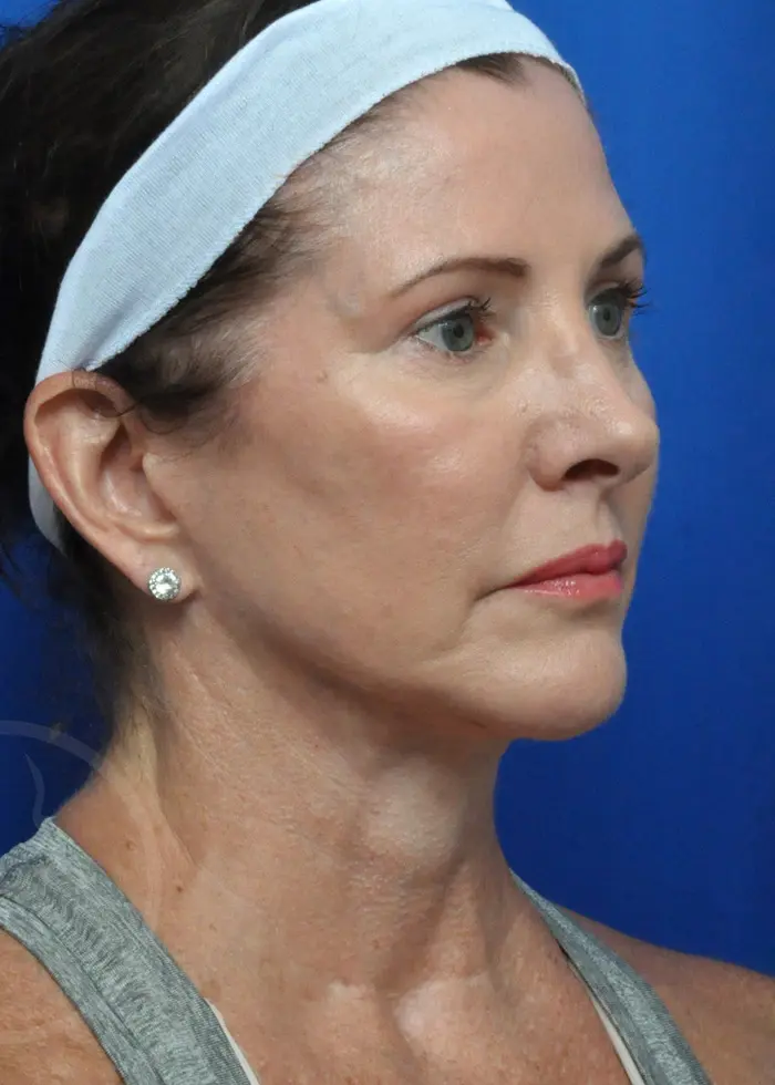Plastic Surgery Before and After Pictures in Jacksonville, FL - Garcia Facial Plastic Surgery