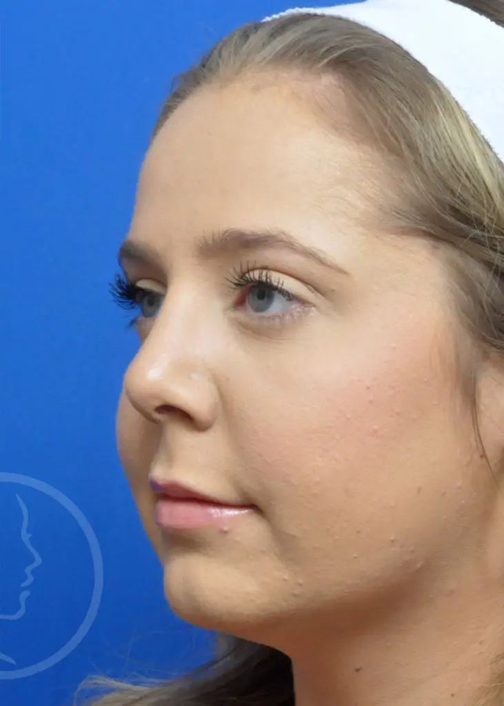 Plastic Surgery Before and After Pictures in Jacksonville, FL - Garcia Facial Plastic Surgery