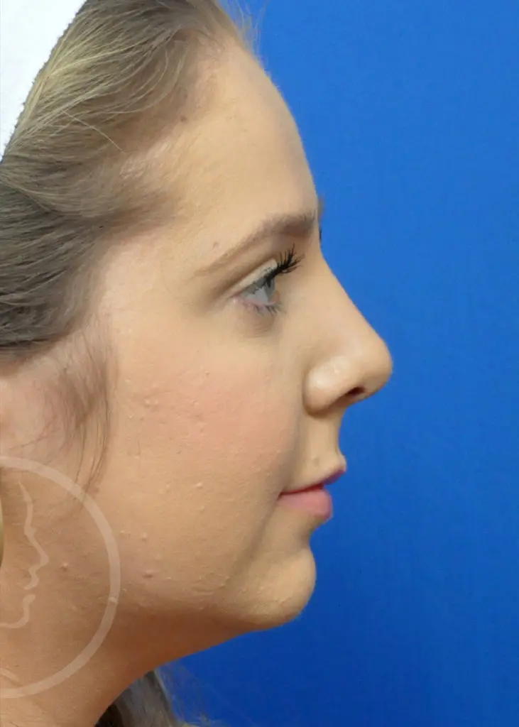 Plastic Surgery Before and After Pictures in Jacksonville, FL - Garcia Facial Plastic Surgery