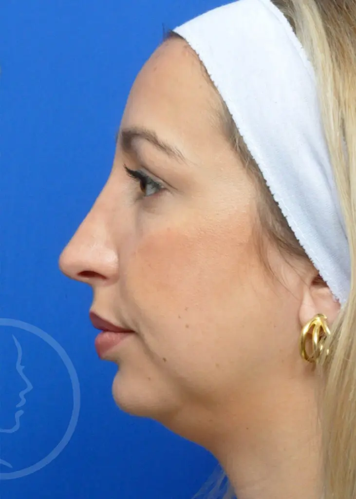 Plastic Surgery Before and After Pictures in Jacksonville, FL - Garcia Facial Plastic Surgery
