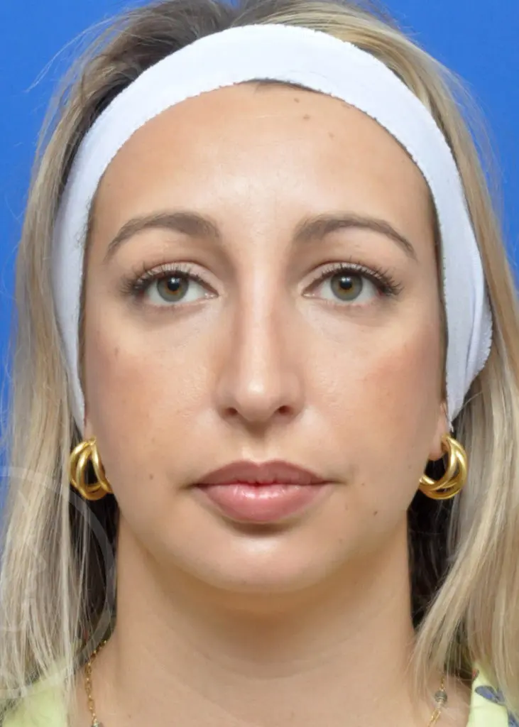 Plastic Surgery Before and After Pictures in Jacksonville, FL - Garcia Facial Plastic Surgery