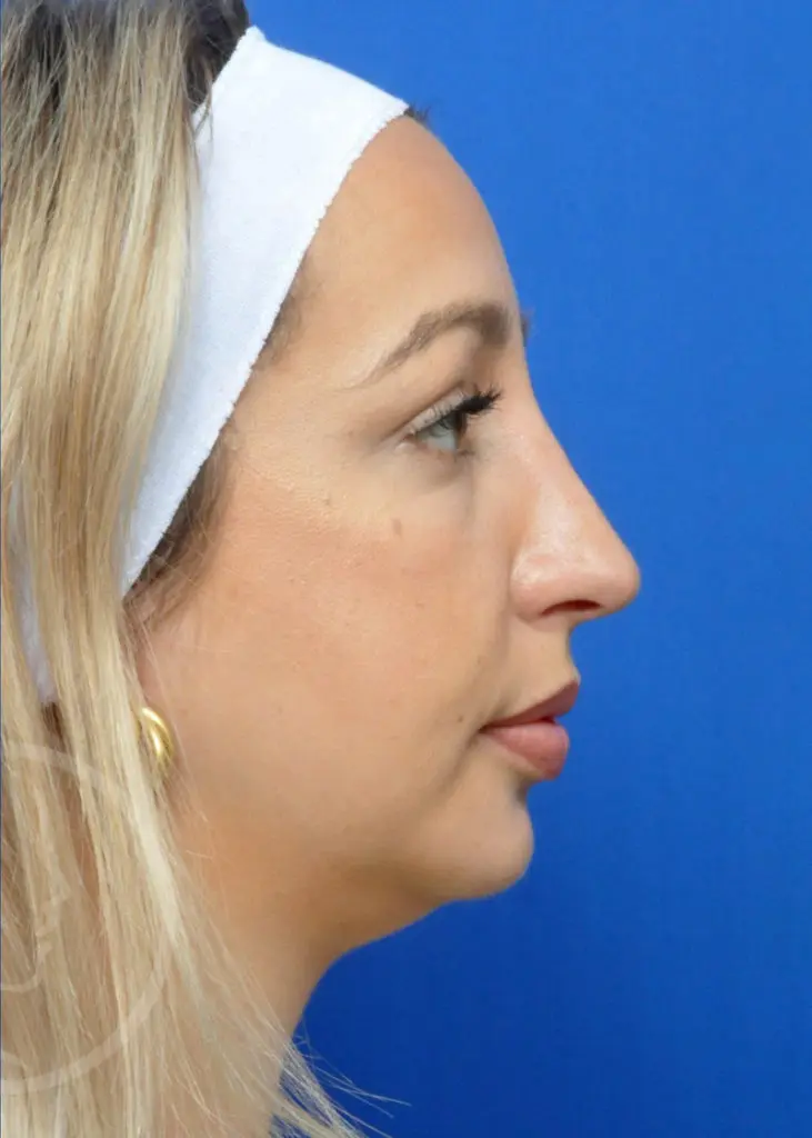 Plastic Surgery Before and After Pictures in Jacksonville, FL - Garcia Facial Plastic Surgery