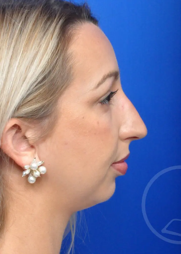 Plastic Surgery Before and After Pictures in Jacksonville, FL - Garcia Facial Plastic Surgery