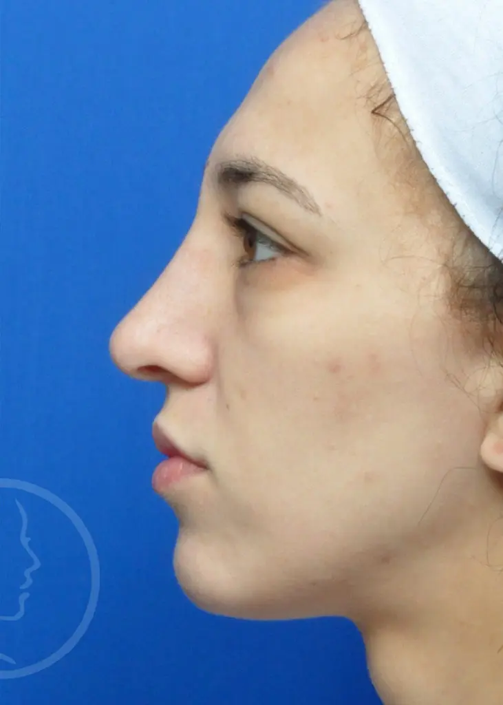 Plastic Surgery Before and After Pictures in Jacksonville, FL - Garcia Facial Plastic Surgery