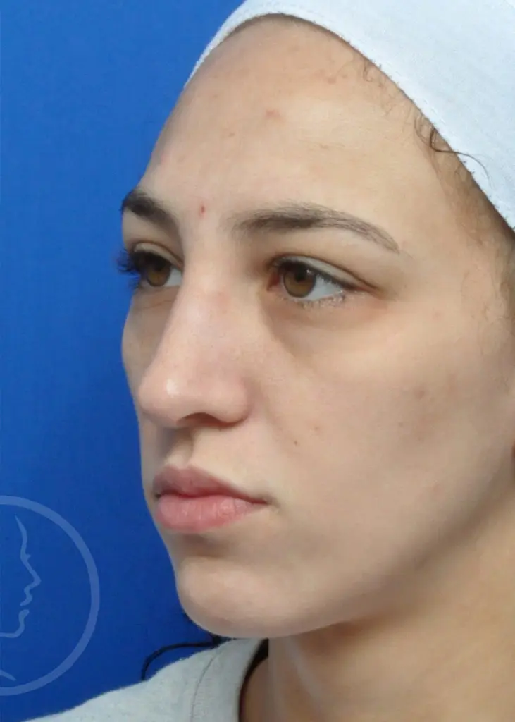 Plastic Surgery Before and After Pictures in Jacksonville, FL - Garcia Facial Plastic Surgery