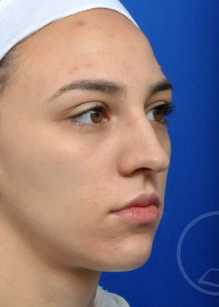 Plastic Surgery Before and After Pictures in Jacksonville, FL - Garcia Facial Plastic Surgery