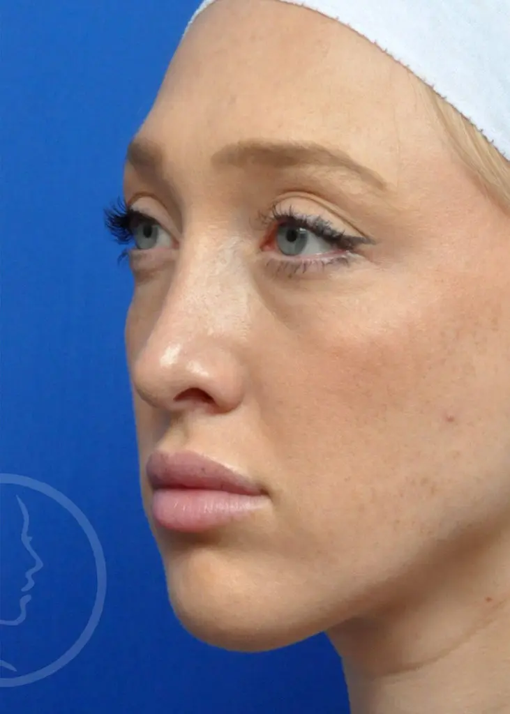 Plastic Surgery Before and After Pictures in Jacksonville, FL - Garcia Facial Plastic Surgery