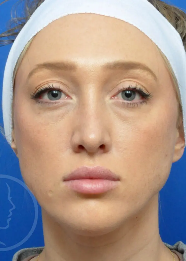 Plastic Surgery Before and After Pictures in Jacksonville, FL - Garcia Facial Plastic Surgery