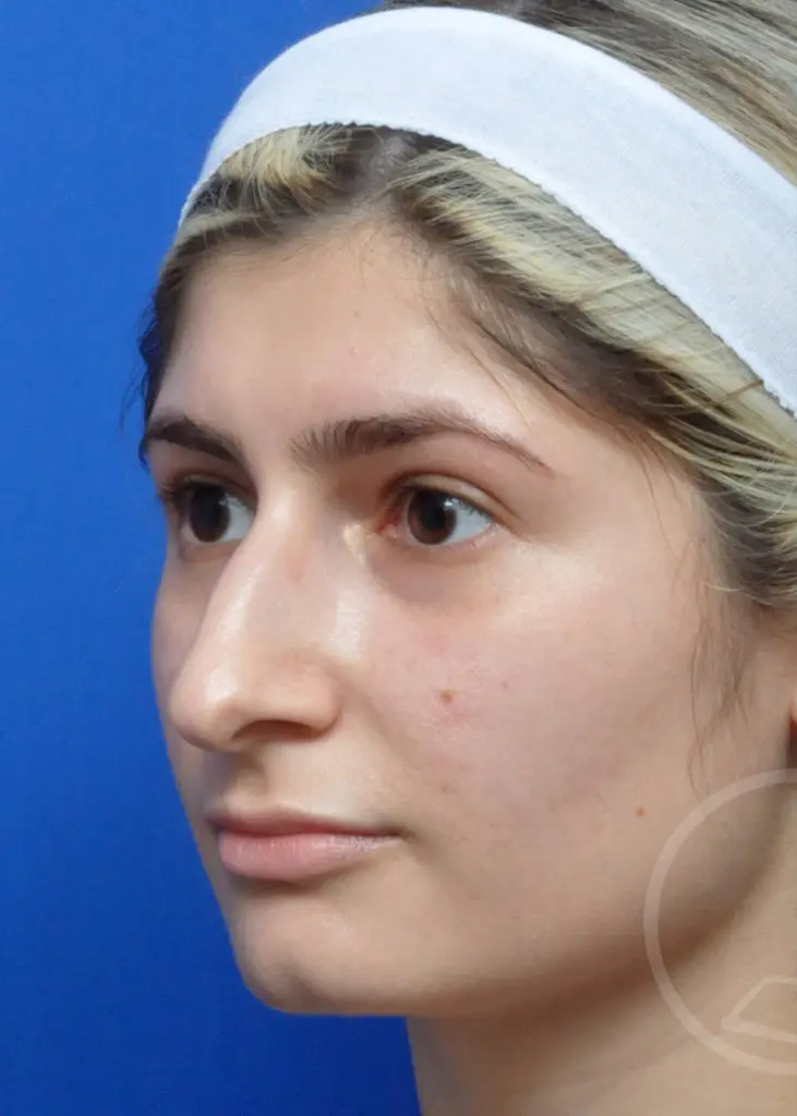 Plastic Surgery Before and After Pictures in Jacksonville, FL - Garcia Facial Plastic Surgery