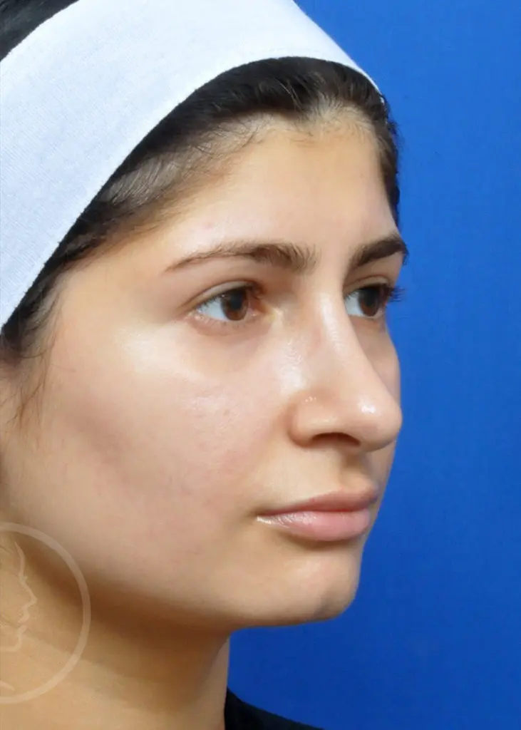 Plastic Surgery Before and After Pictures in Jacksonville, FL - Garcia Facial Plastic Surgery