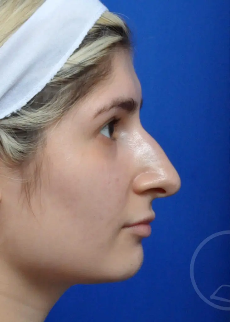 Plastic Surgery Before and After Pictures in Jacksonville, FL - Garcia Facial Plastic Surgery