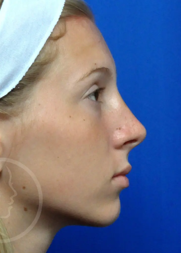 Plastic Surgery Before and After Pictures in Jacksonville, FL - Garcia Facial Plastic Surgery