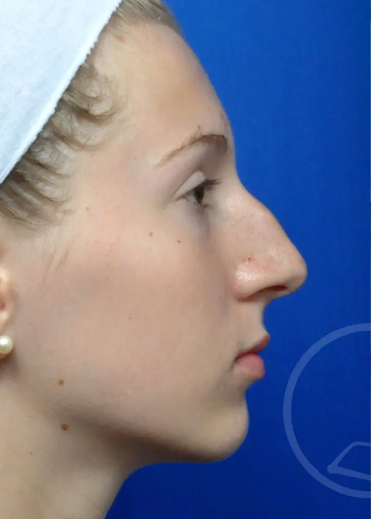 Plastic Surgery Before and After Pictures in Jacksonville, FL - Garcia Facial Plastic Surgery