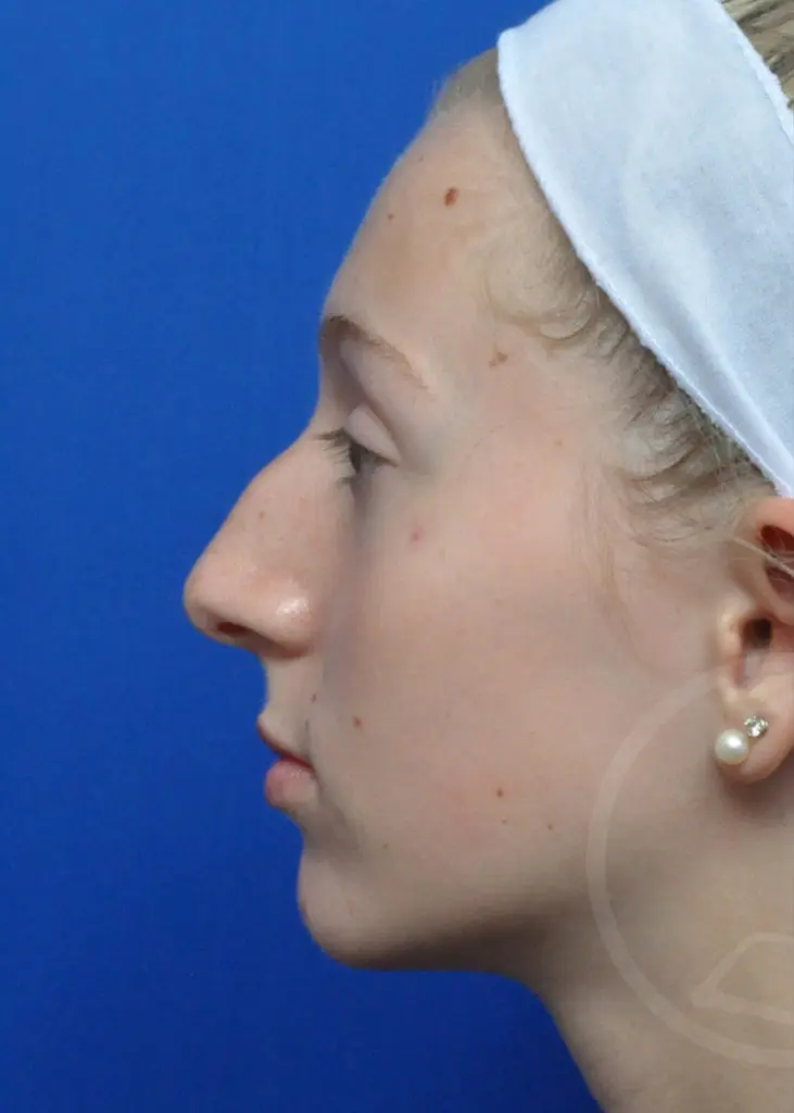 Plastic Surgery Before and After Pictures in Jacksonville, FL - Garcia Facial Plastic Surgery