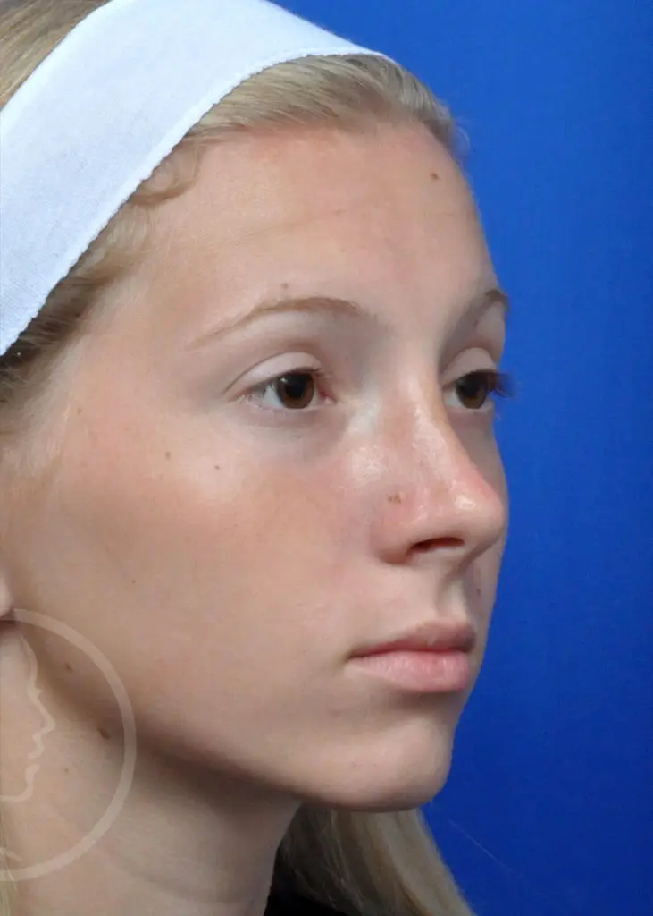Plastic Surgery Before and After Pictures in Jacksonville, FL - Garcia Facial Plastic Surgery