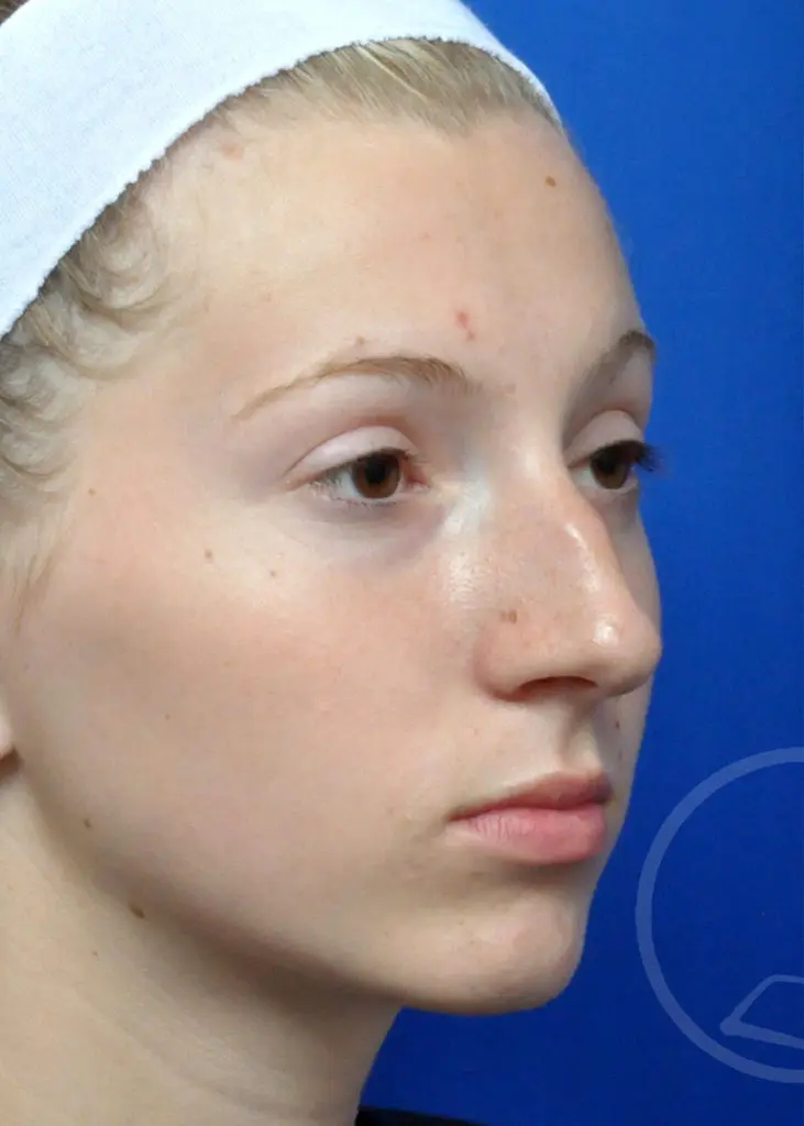 Plastic Surgery Before and After Pictures in Jacksonville, FL - Garcia Facial Plastic Surgery