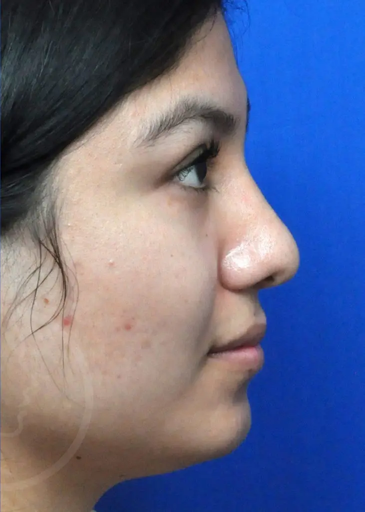 Plastic Surgery Before and After Pictures in Jacksonville, FL - Garcia Facial Plastic Surgery