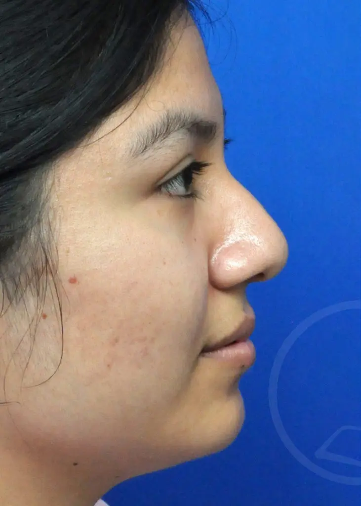 Plastic Surgery Before and After Pictures in Jacksonville, FL - Garcia Facial Plastic Surgery