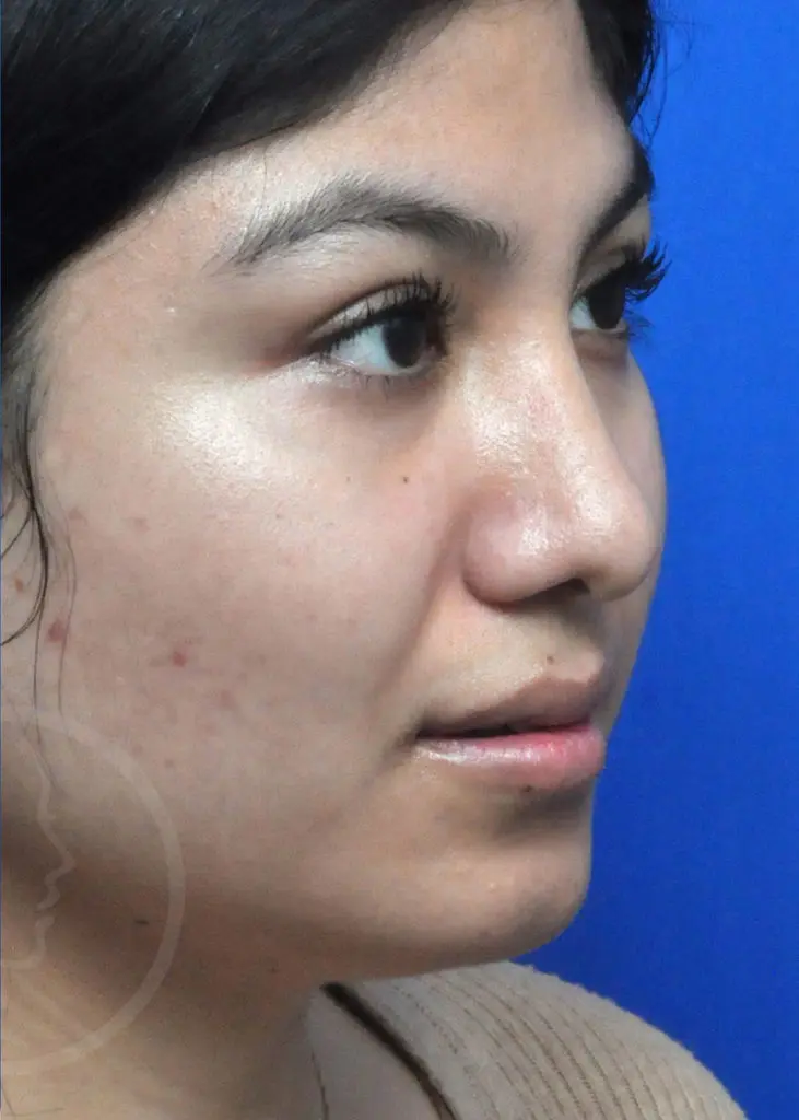 Plastic Surgery Before and After Pictures in Jacksonville, FL - Garcia Facial Plastic Surgery